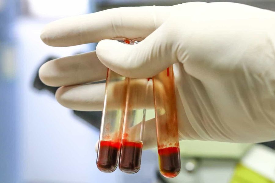 coagulacao-sangue-hemorragia-avc-trombose